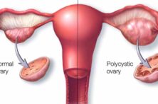 همه چیز درباره سندرم تخمدان پلی‌کیستیک (PCOS)