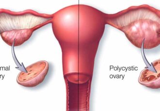 همه چیز درباره سندرم تخمدان پلی‌کیستیک (PCOS)