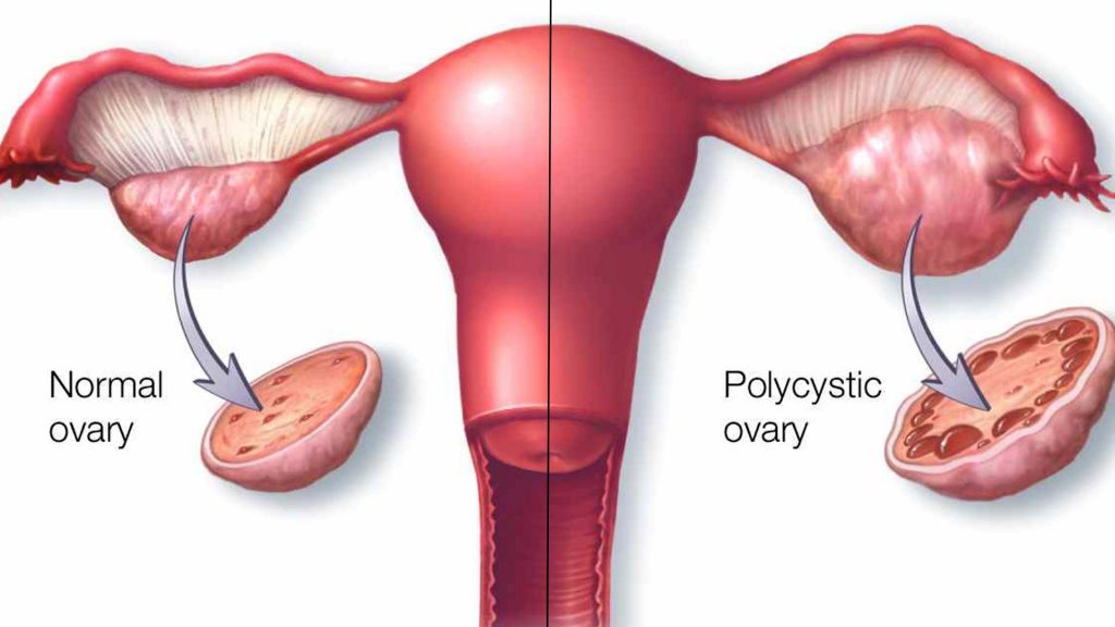 همه چیز درباره سندرم تخمدان پلی‌کیستیک (PCOS)