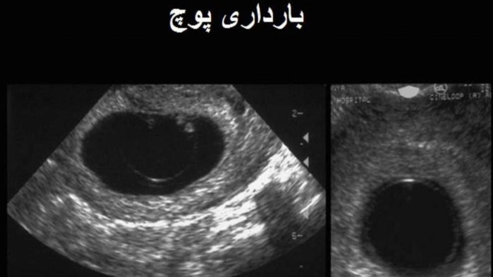 حاملگی مولار یا پوچ در یک نگاه عمیق