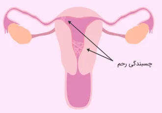 چسبندگی رحم، مشکلی که باروری را تهدید می‌کند