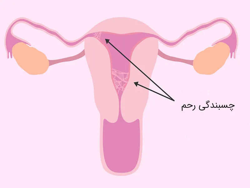 چسبندگی رحم، مشکلی که باروری را تهدید می‌کند