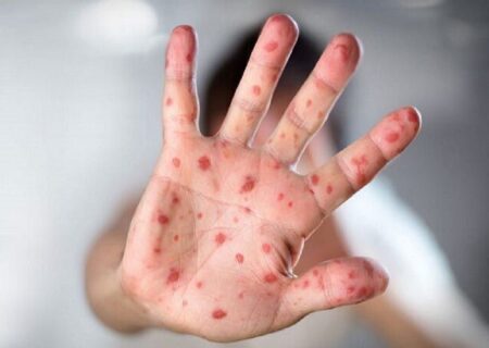 زنگ خطر «سرخک» در شمال کشور