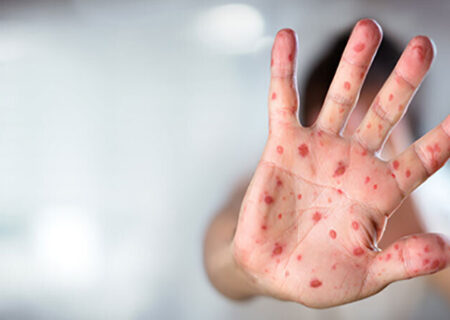 زنگ خطر «سرخک» در شمال کشور