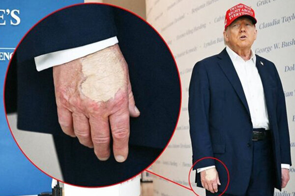 بیماری ترامپ دقیقا چیست؟