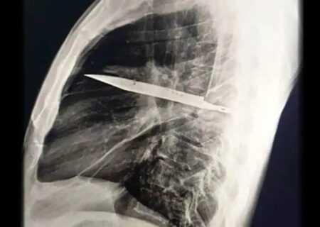 کشف چاقو در سینه مرد تانزانیایی