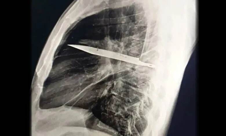 کشف چاقو در سینه مرد تانزانیایی