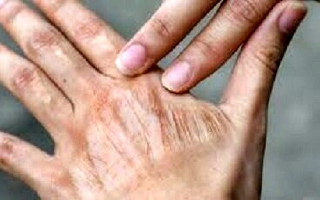 چگونه از خشکی پوست در پاییز جلوگیری کنیم؟