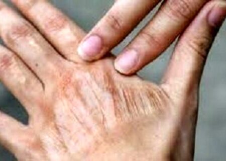 چگونه از خشکی پوست در پاییز جلوگیری کنیم؟