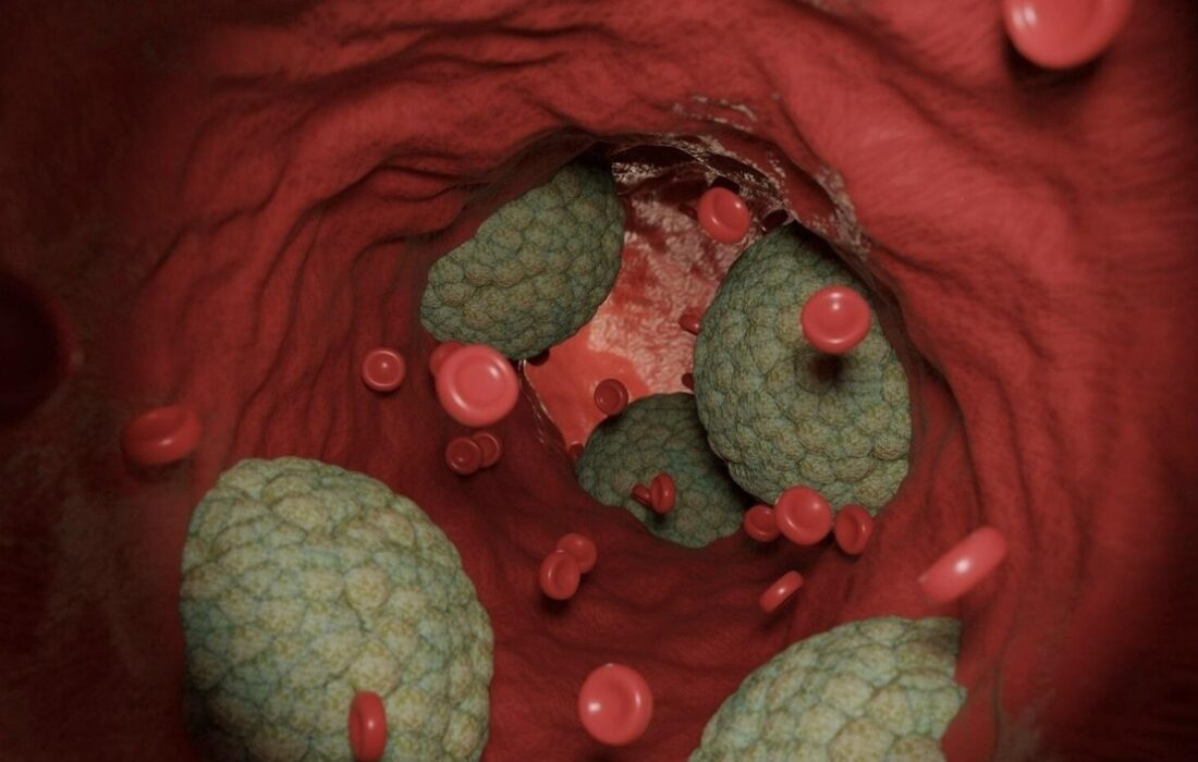 برخی حملات قلبی شاید نتیجه‌ی فعالیت میکروب‌ها باشد