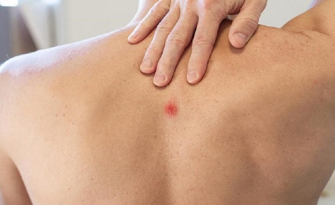 جوش روی کمر نشانه چیست و چگونه درمان میشود؟