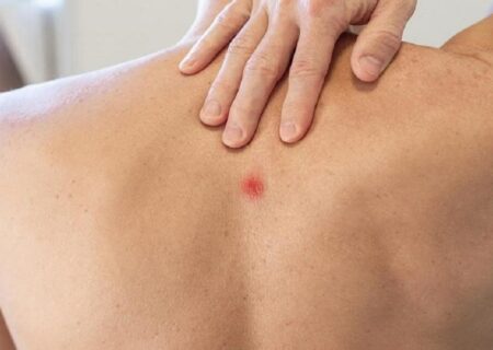 جوش روی کمر نشانه چیست و چگونه درمان می‌شود؟