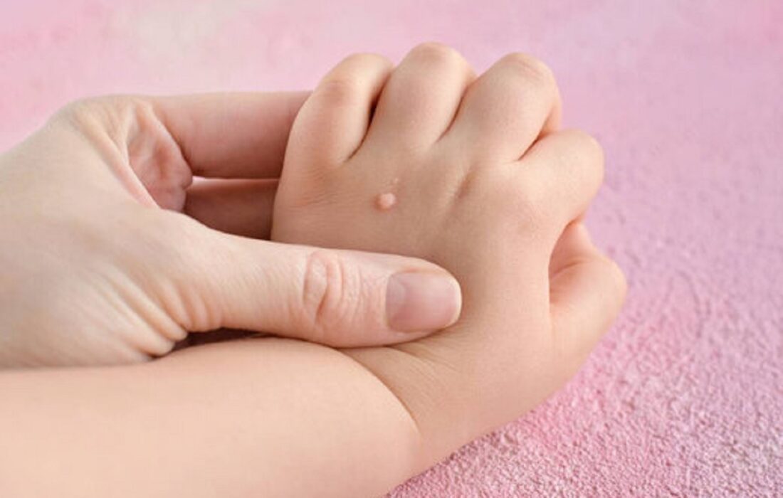 تفاوت خال گوشتی و زگیل چیست؟/ آیا کندن زگیل با ناخنگیر یا بستن نخ خطرناک است؟