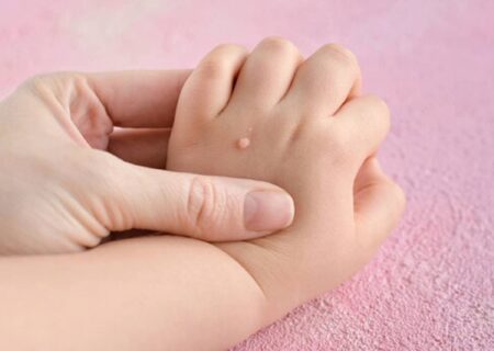 تفاوت خال گوشتی و زگیل چیست؟/ آیا کندن زگیل با ناخنگیر یا بستن نخ خطرناک است؟