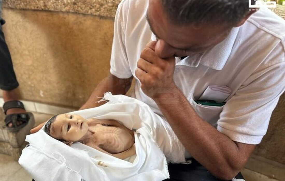 شهادت ۳ نفر در غزه در پی گرسنگی و سوء تغذیه