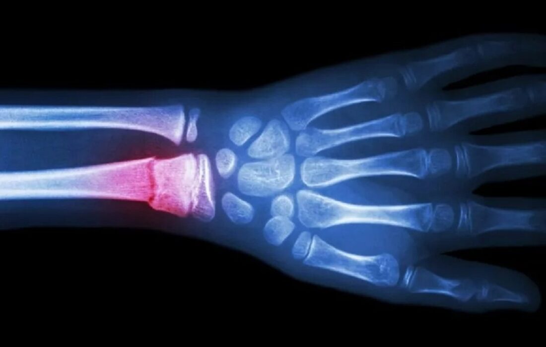 «تفنگ چسب» برای چاپ سهبعدی استخوان؛ ترمیم شکستگیها آسانتر میشود