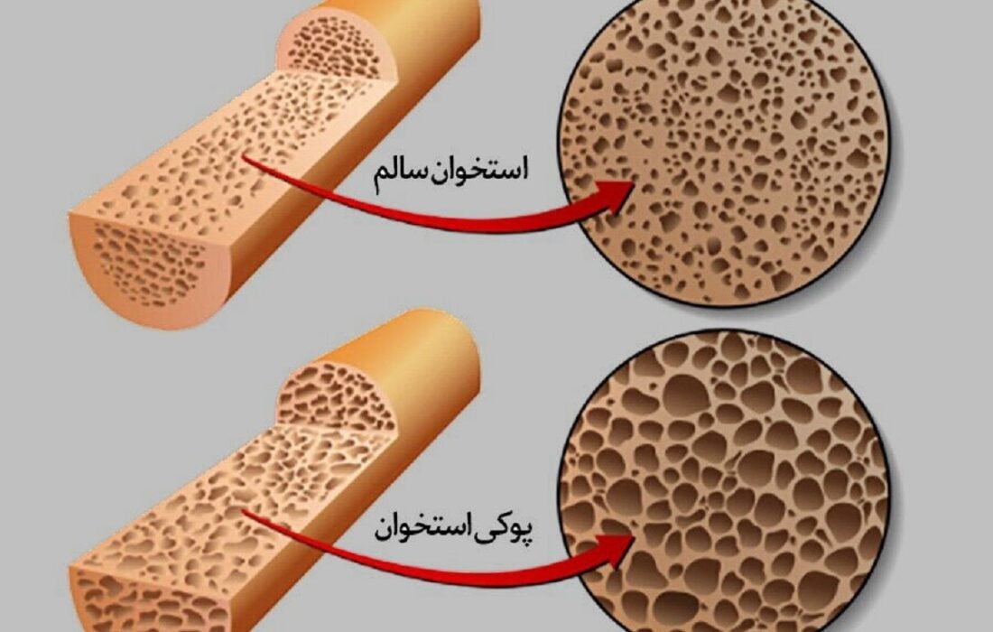 این عادت غلط رایج باعث پوکی و شکستگی استخوان میشود