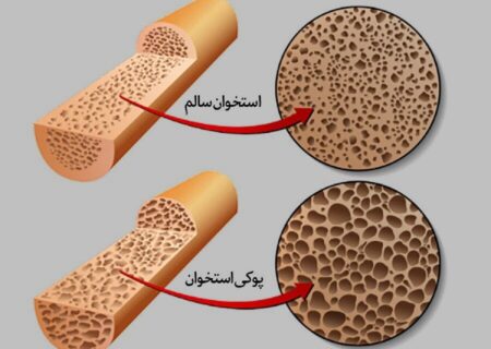 این عادت غلط رایج باعث پوکی و شکستگی استخوان می‌شود