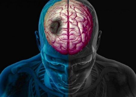 ترکیبات طبیعی، امید تازه در کاهش آسیب‌های سکته مغزی