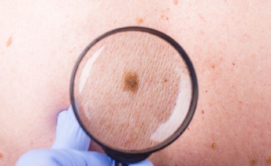 مکملی که خطر بازگشت سرطان پوست را کاهش میدهد