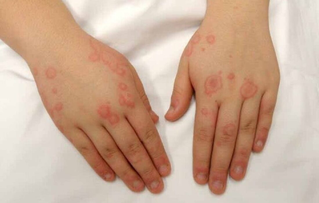 بیماری شایع در بین بانوان؛ مروری بر وضعیت «سلنا گومز» و بیماری غیرقابل درمانش