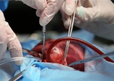 چنانه: اعضای نوجوان ۱۷ ساله رامهرمزی به سه بیمار نیازمند اهدا شد