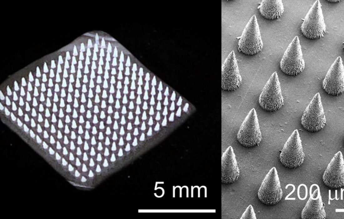 نوآوری ایرانی در نانو؛ تحول تولید میکرونیدل‌های تجزیه‌پذیر