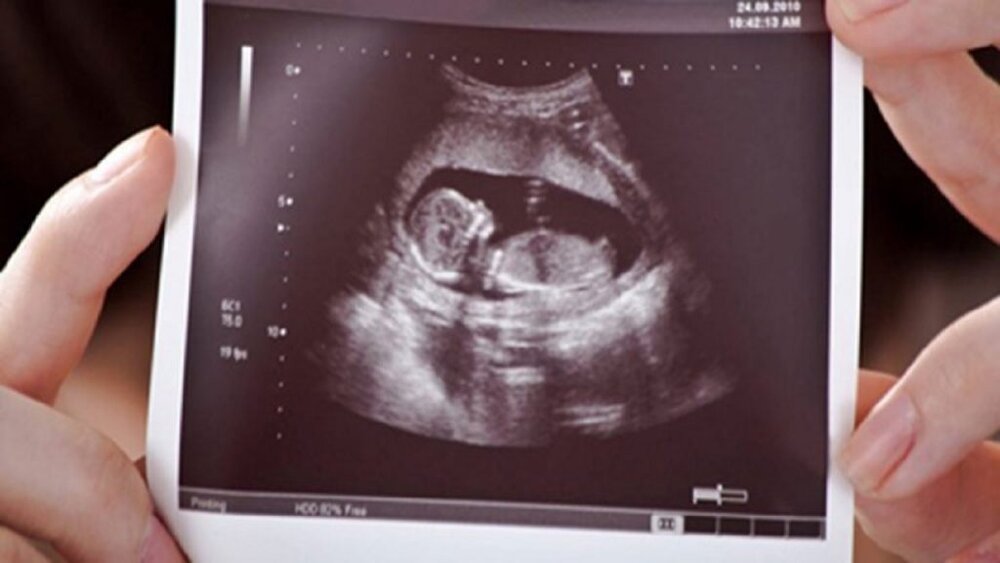 بیمه تکمیلی حامی مکملهای ناباروری در خراسان شمالی/ سهم ۱۰ میلیونی بیماران نابارور در بعضی نسخهها