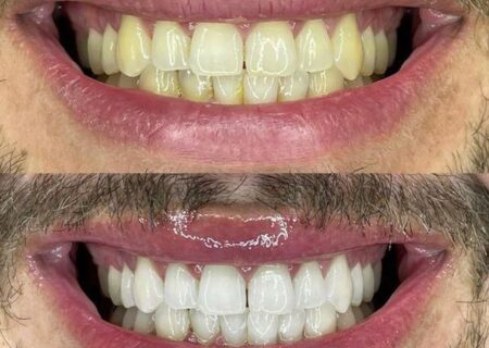 انواع کامپوزیت دندان و کاربرد آن‌ها