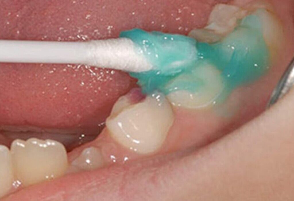 اجرای طرح وارنیش فلوراید تراپی در مدارس شهرستان گناوه