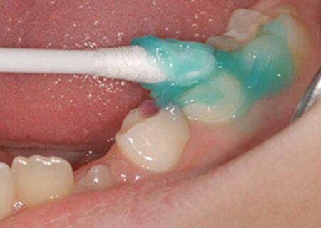 اجرای طرح وارنیش فلوراید تراپی در مدارس شهرستان گناوه