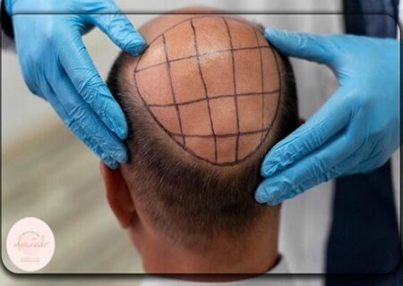 چرا نتیجه کاشت مو برای همه رضایت بخش نیست؟