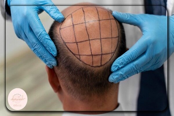 چرا نتیجه کاشت مو برای همه رضایت بخش نیست؟