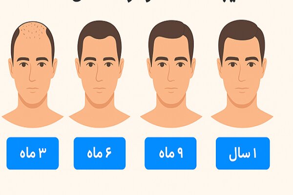 چه زمانی میتوان نتیجه کاشت مو را مشاهده کرد؟