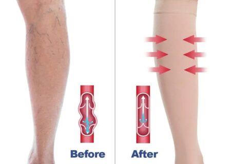 جوراب‌های واریس و نقش آن‌ها در بهبود گردش خون