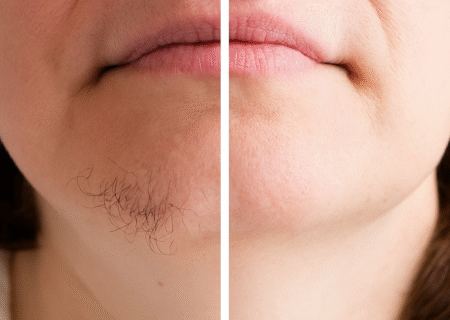 لیزر موهای زائد: راهنمای جامع، مزایا، معایب و نکات مهم