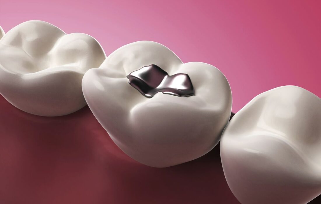 راهنمای جامع مواد پرکننده دندان: مقایسه آمالگام، کامپوزیت و گلاس آینومر