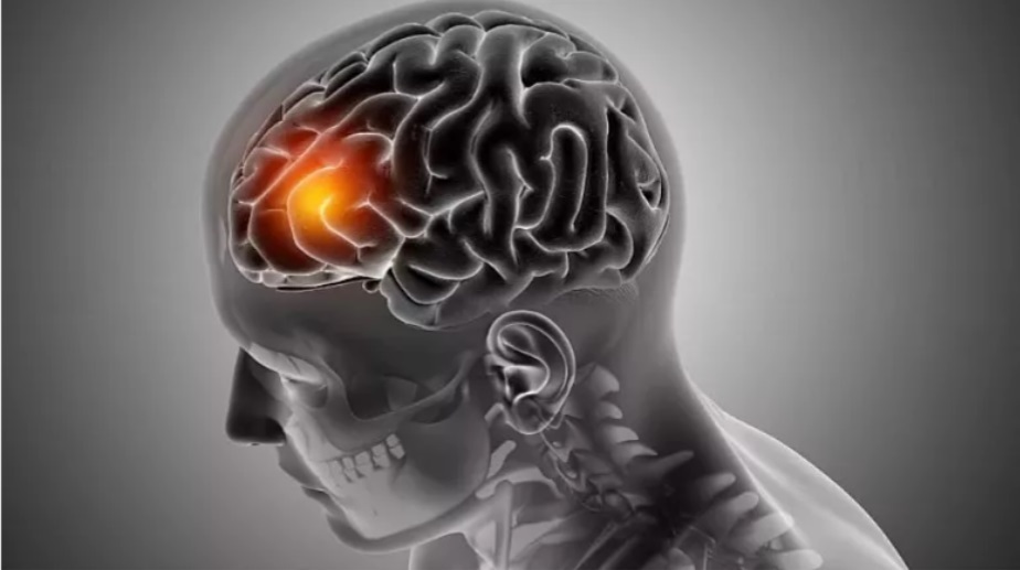 چربی خطرناک، تهدیدی جدی برای تسریع روند پیری مغز