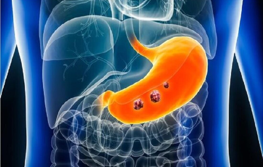 با این سبک زندگی و عادات غذایی از “سرطان معده” پیشگیری کنید