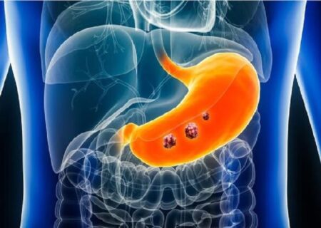 با این سبک زندگی و عادات غذایی از “سرطان معده” پیشگیری کنید
