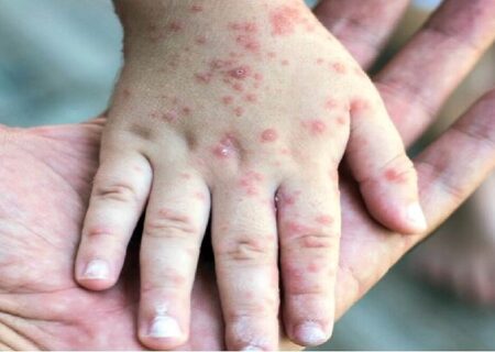 مرگ دلخراش نوزاد کانادایی در پی ابتلا به سرخک؛ همزمان با شیوع گسترده این بیماری