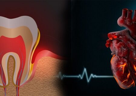 ارتباط دندان‌های خراب و سکته قلبی: چگونه این دو به هم مرتبط هستند؟