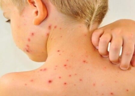 هشدار جدی شیوع سرخک در شمال سیدنی صادر شد