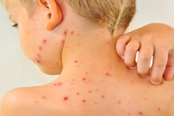 هشدار جدی شیوع سرخک در شمال سیدنی صادر شد