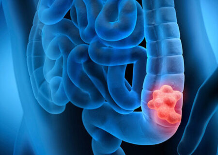 تدین: کاهش نگران‌کننده سن ابتلا به سرطان روده بزرگ در ایران