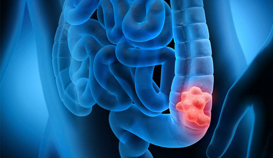 تدین: کاهش نگرانکننده سن ابتلا به سرطان روده بزرگ در ایران