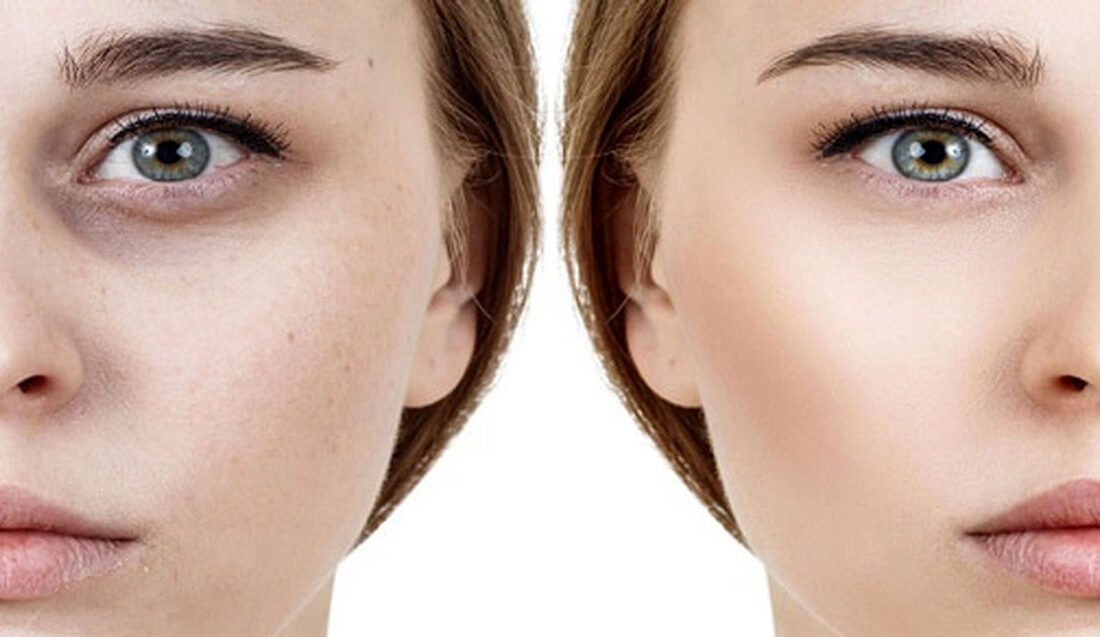 اندولیفت زیر چشم: روشی نوین با مزایای شگفتانگیز