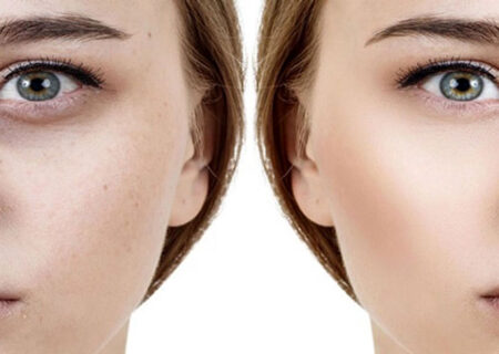 اندولیفت زیر چشم: روشی نوین با مزایای شگفت‌انگیز